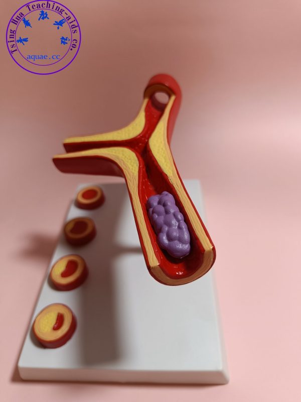 冠心病血管動脈硬化模型 Coronary Heart Disease Model：圖片 4