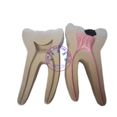 可半開蛀牙模型  Decayed Tooth Cross Section Display Model