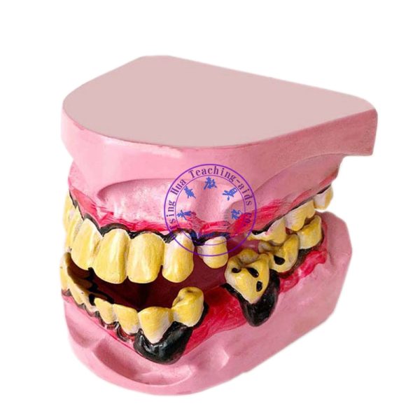 煙民牙齒模型 Human Smokers Teeth Model