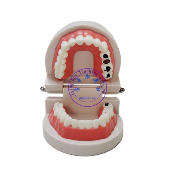 牙齒模型1：1(蛀牙款)附牙刷 Decayed Tooth Model