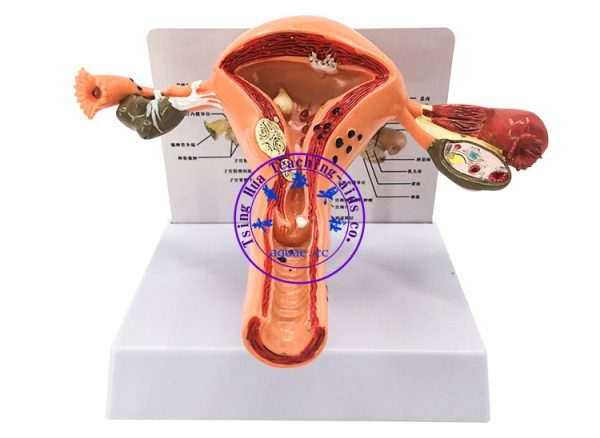 子宮病變模型 Sick Uterus Model